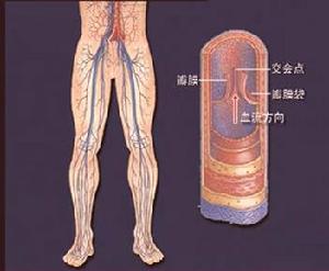 生活中导致脉管炎的原因有哪些？苏州怎么治疗？